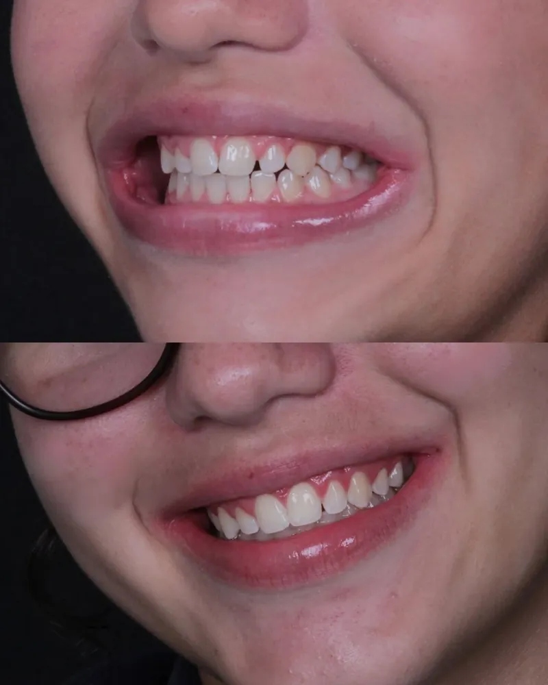 Sorriso antes e depois do tratamento ortodôntico
