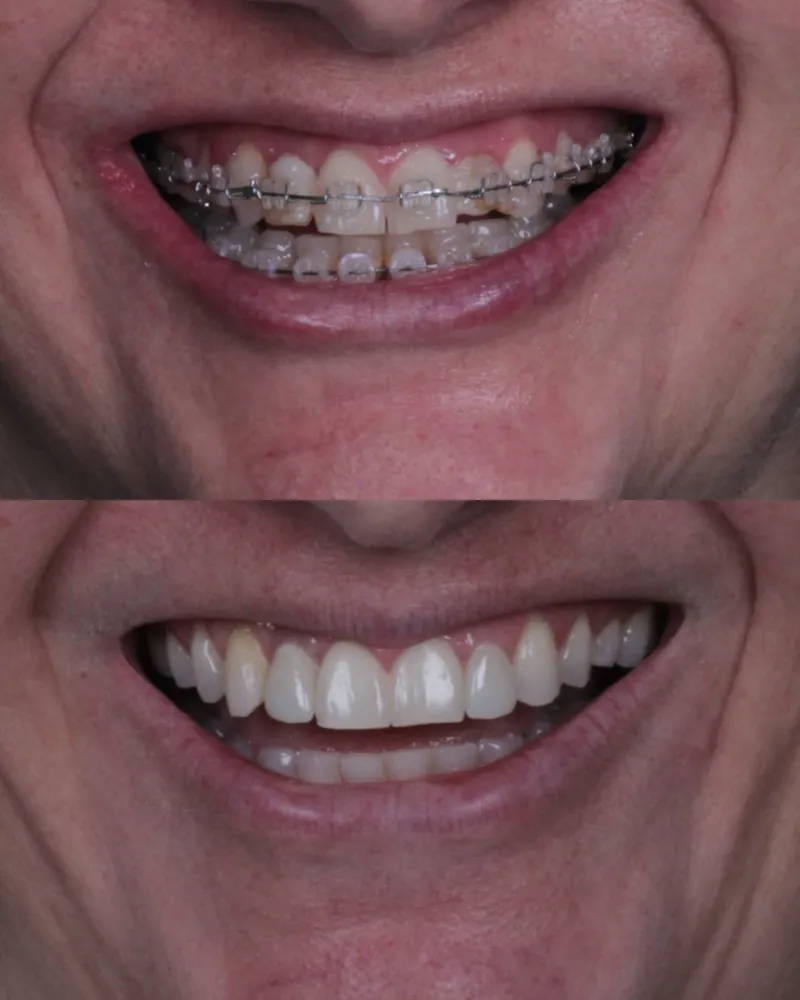 Sorriso durante o tratamento com aparelho e depois da conclusão