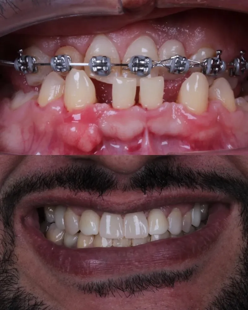 Dentes durante o tratamento com aparelho e sorriso depois da conclusão